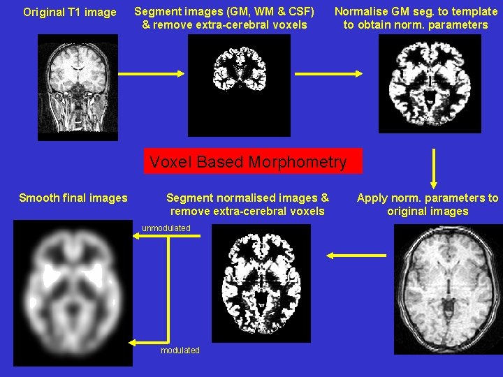 Original T 1 image Segment images (GM, WM & CSF) & remove extra-cerebral voxels