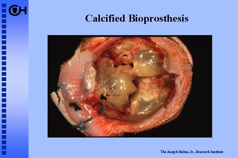 Calcified Bioprosthesis The Joseph Stokes, Jr. , Research Institute 