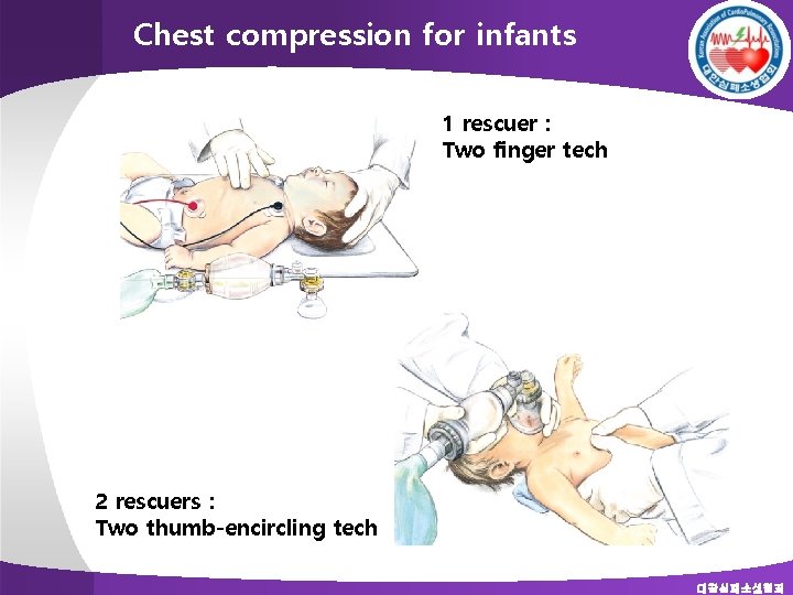 Chest compression for infants 1 rescuer : Two finger tech 2 rescuers : Two