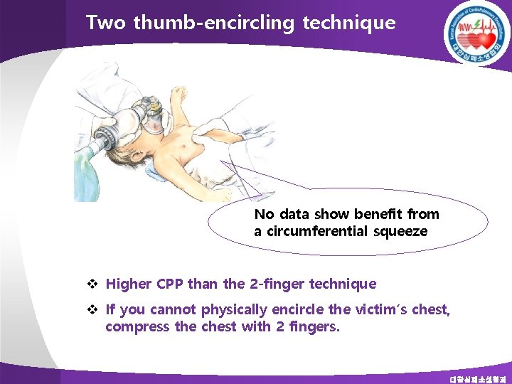 Two thumb-encircling technique No data show benefit from a circumferential squeeze v Higher CPP