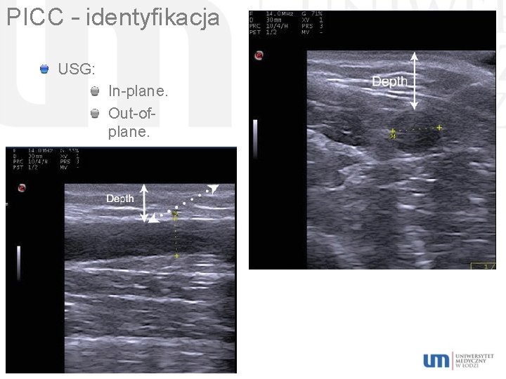 PICC – identyfikacja USG: In-plane. Out-ofplane. 