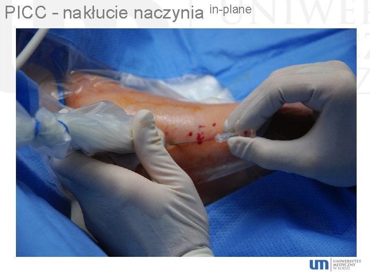 PICC – nakłucie naczynia in-plane 