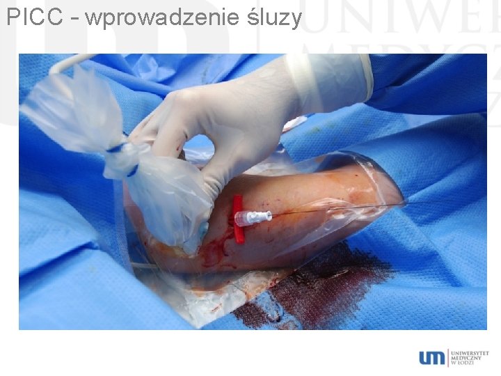 PICC – wprowadzenie śluzy 