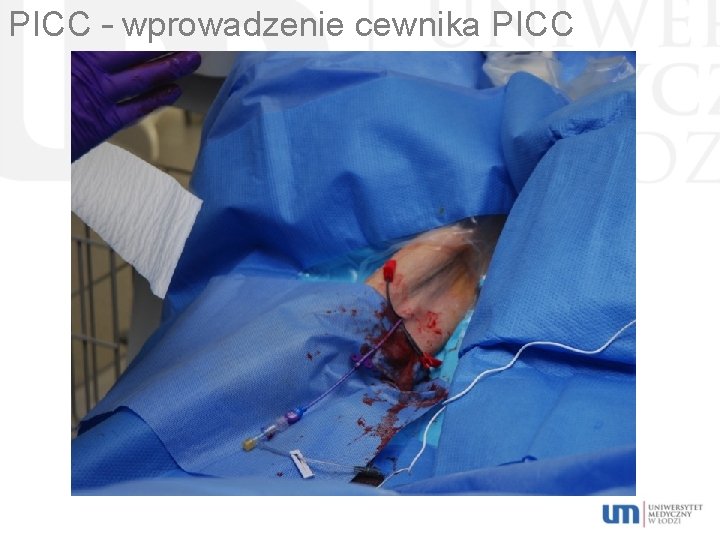 PICC – wprowadzenie cewnika PICC 