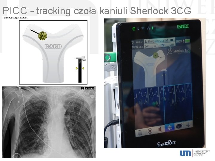 PICC – tracking czoła kaniuli Sherlock 3 CG 