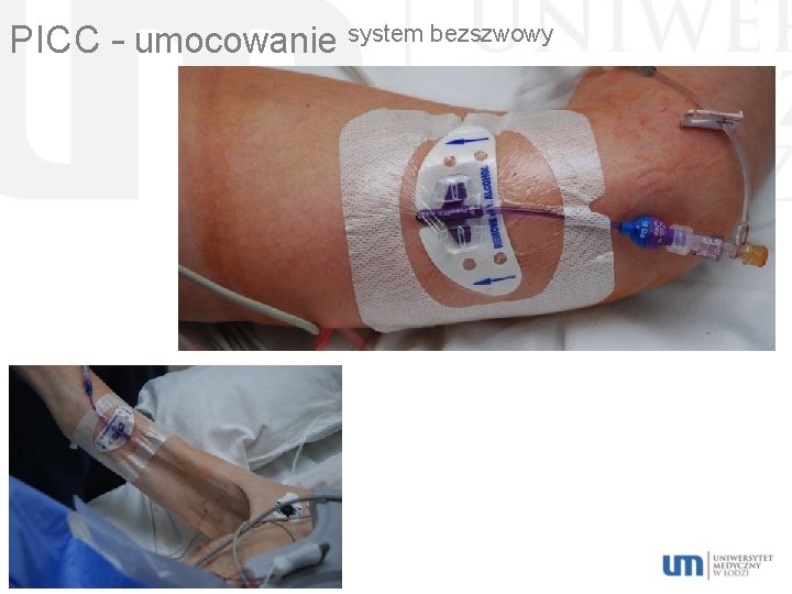 PICC – umocowanie system bezszwowy 