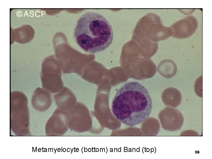 Metamyelocyte (bottom) and Band (top) 35 