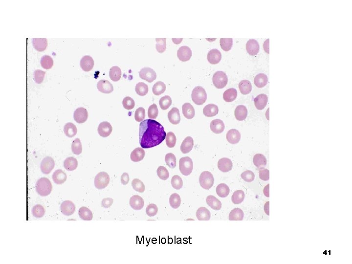 Myeloblast 41 