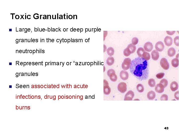 Toxic Granulation n Large, blue-black or deep purple granules in the cytoplasm of neutrophils