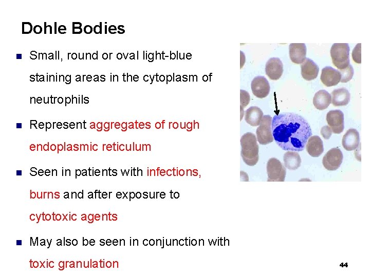 Dohle Bodies n Small, round or oval light-blue staining areas in the cytoplasm of