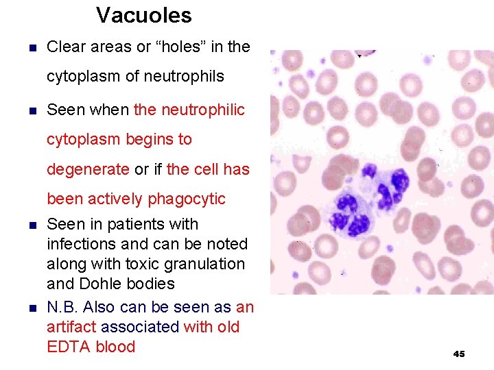 Vacuoles n Clear areas or “holes” in the cytoplasm of neutrophils n Seen when