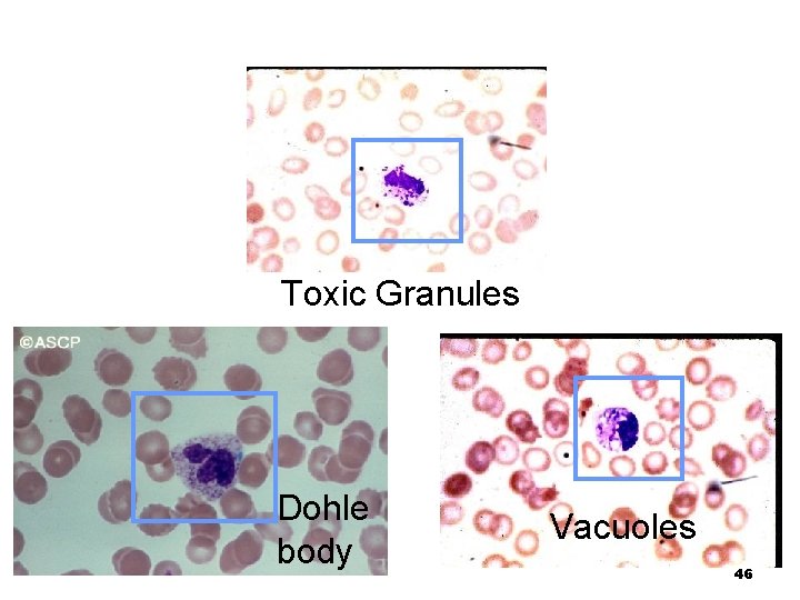 Toxic Granules Dohle body Vacuoles 46 