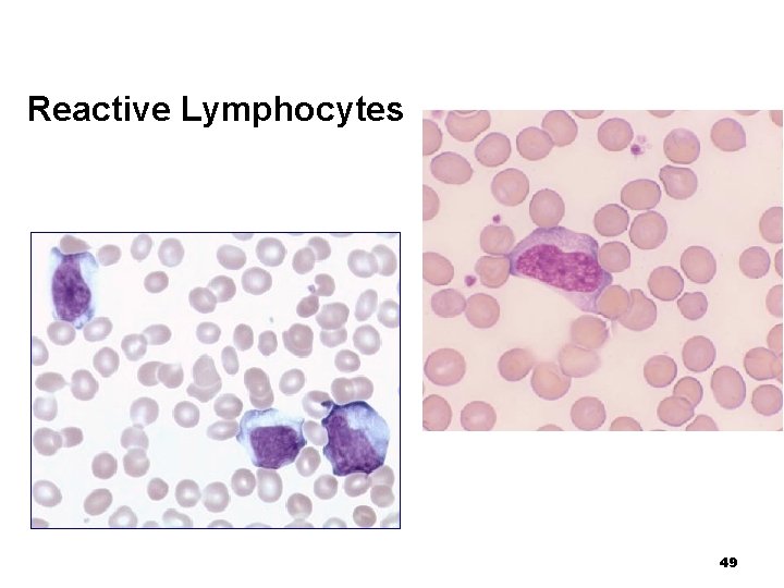 Reactive Lymphocytes 49 