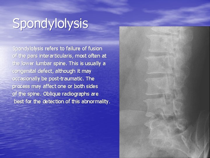 Spondylolysis refers to failure of fusion of the pars interarticularis, most often at the