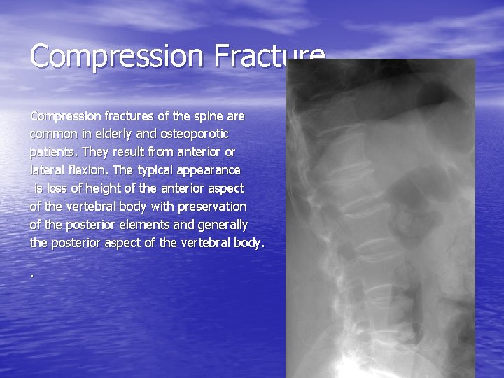 Compression Fracture Compression fractures of the spine are common in elderly and osteoporotic patients.