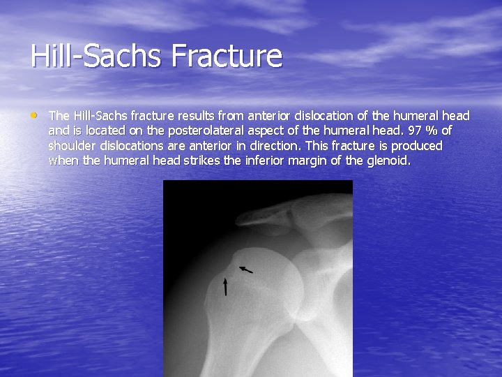 Hill-Sachs Fracture • The Hill-Sachs fracture results from anterior dislocation of the humeral head