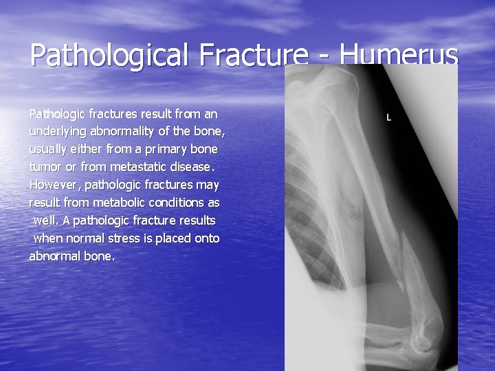 Pathological Fracture - Humerus Pathologic fractures result from an underlying abnormality of the bone,