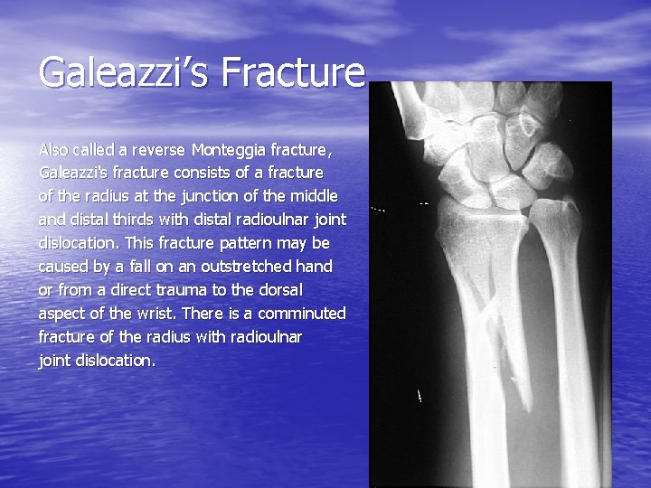 Galeazzi’s Fracture Also called a reverse Monteggia fracture, Galeazzi's fracture consists of a fracture