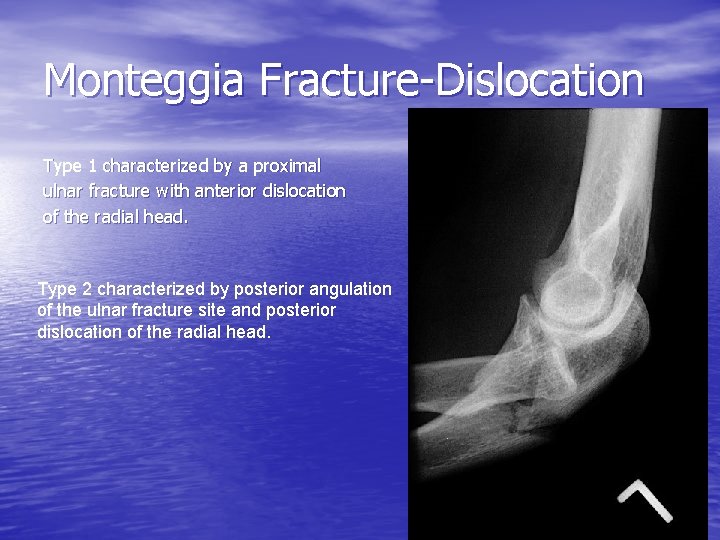 Monteggia Fracture-Dislocation Type 1 characterized by a proximal ulnar fracture with anterior dislocation of