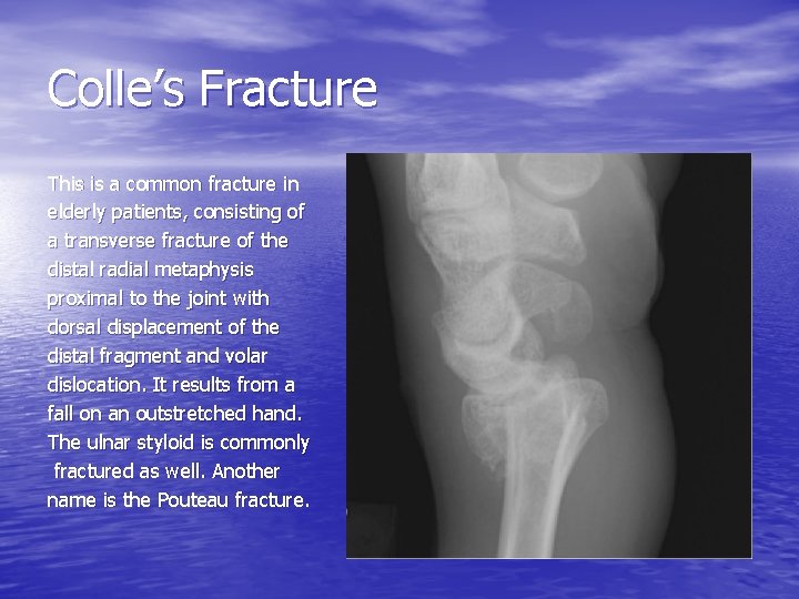 Colle’s Fracture This is a common fracture in elderly patients, consisting of a transverse