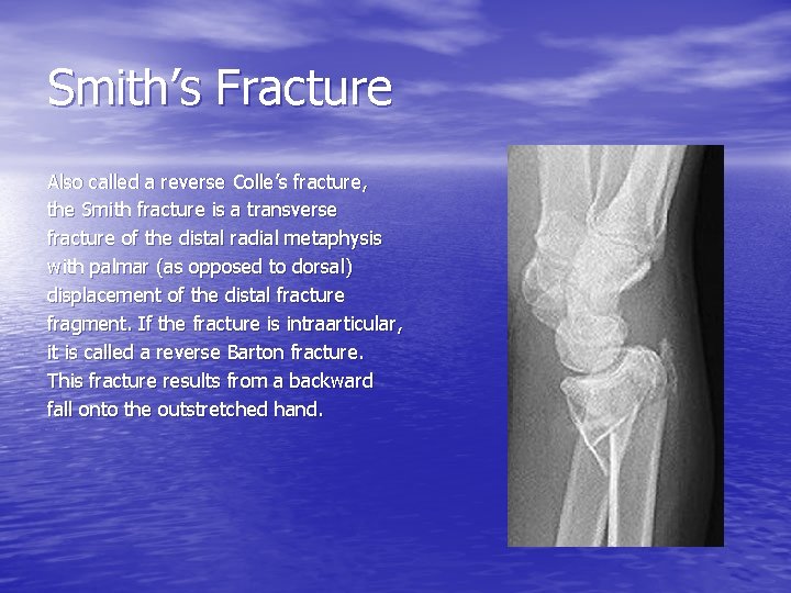 Smith’s Fracture Also called a reverse Colle’s fracture, the Smith fracture is a transverse