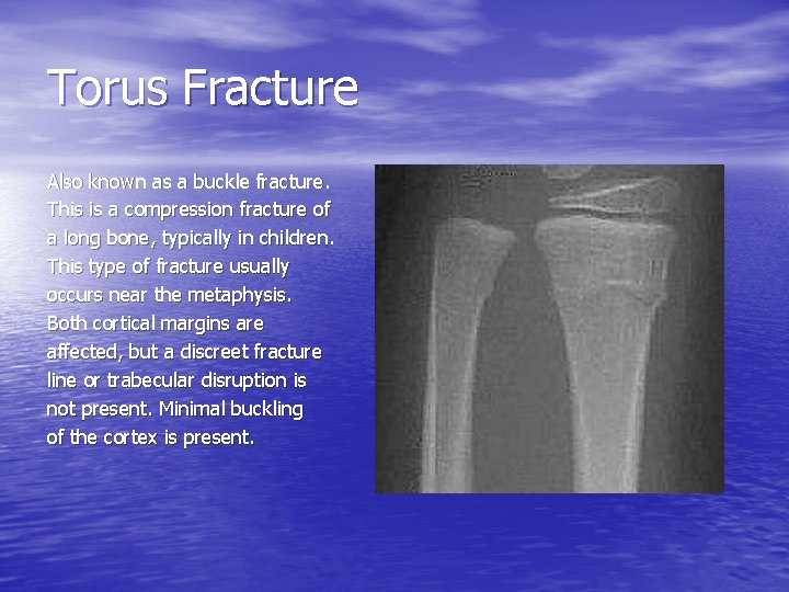 Torus Fracture Also known as a buckle fracture. This is a compression fracture of