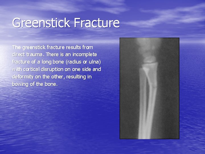 Greenstick Fracture The greenstick fracture results from direct trauma. There is an incomplete fracture