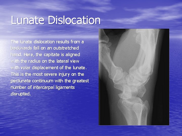 Lunate Dislocation The lunate dislocation results from a backwards fall on an outstretched hand.