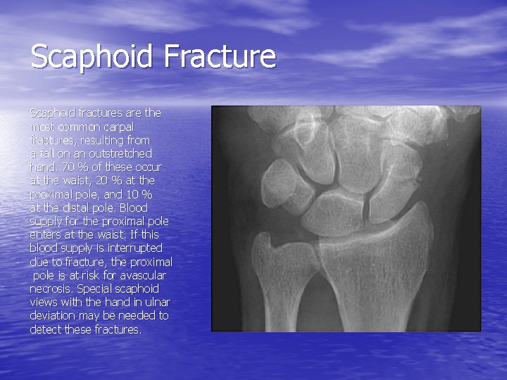 Scaphoid Fracture Scaphoid fractures are the most common carpal fractures, resulting from a fall