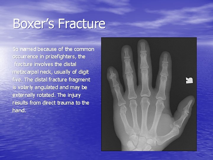 Boxer’s Fracture So named because of the common occurrence in prizefighters, the fracture involves