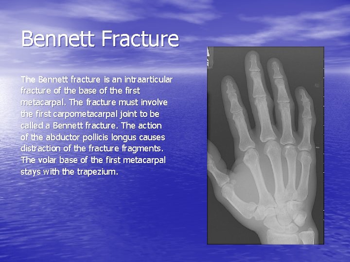 Bennett Fracture The Bennett fracture is an intraarticular fracture of the base of the