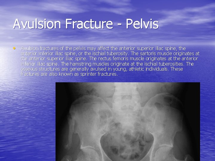 Avulsion Fracture - Pelvis • Avulsion fractures of the pelvis may affect the anterior