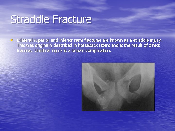 Straddle Fracture • Bilateral superior and inferior rami fractures are known as a straddle