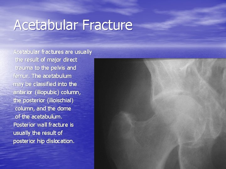 Acetabular Fracture Acetabular fractures are usually the result of major direct trauma to the