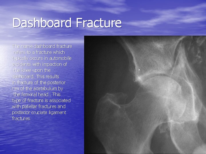 Dashboard Fracture The name dashboard fracture refers to a fracture which typically occurs in