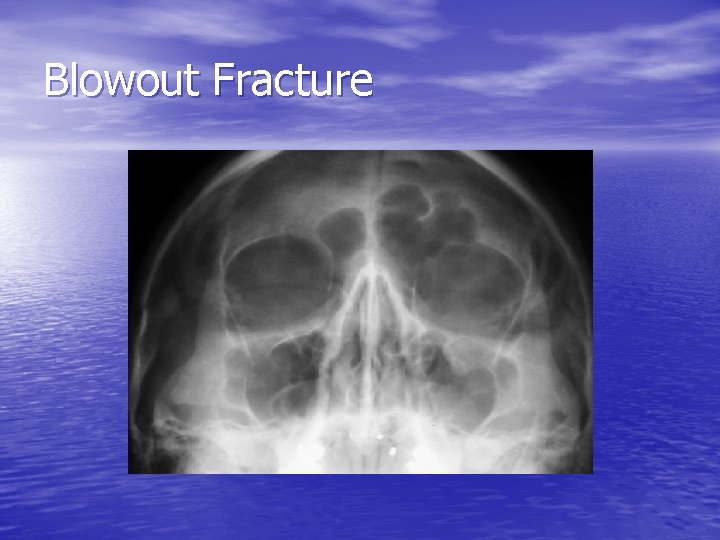 Blowout Fracture 