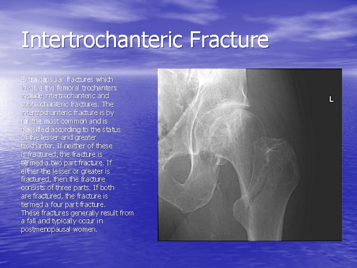 Intertrochanteric Fracture Extra capsular fractures which involve the femoral trochanters include intertrochanteric and subtrochanteric