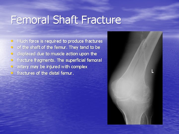 Femoral Shaft Fracture • • • Much force is required to produce fractures of