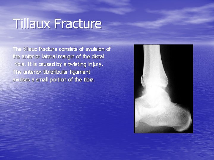 Tillaux Fracture The tillaux fracture consists of avulsion of the anterior lateral margin of