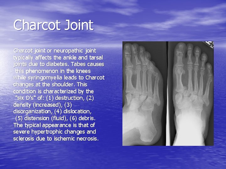 Charcot Joint Charcot joint or neuropathic joint typically affects the ankle and tarsal joints