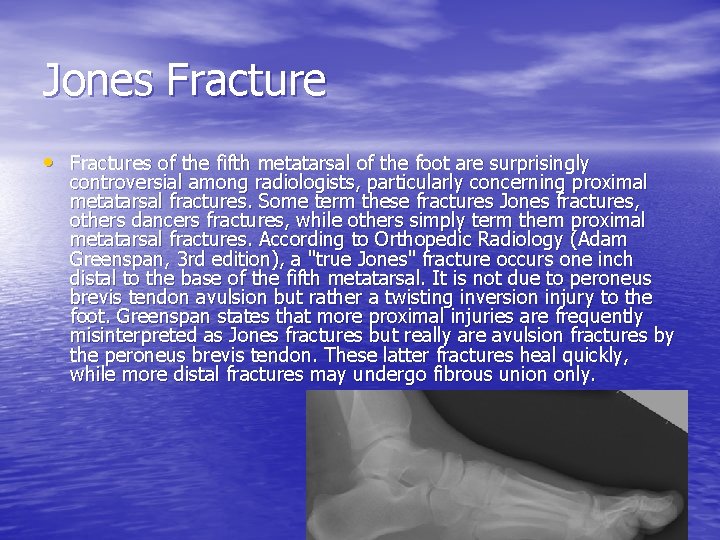 Jones Fracture • Fractures of the fifth metatarsal of the foot are surprisingly controversial