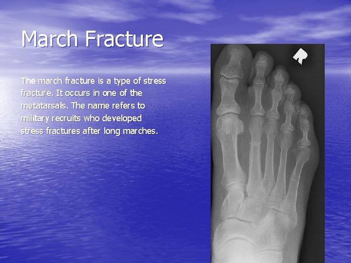 March Fracture The march fracture is a type of stress fracture. It occurs in