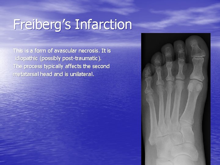 Freiberg’s Infarction This is a form of avascular necrosis. It is idiopathic (possibly post-traumatic).