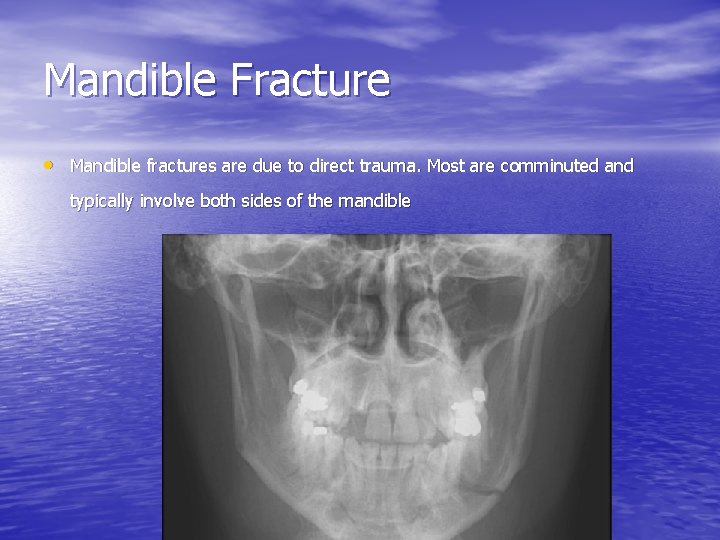 Mandible Fracture • Mandible fractures are due to direct trauma. Most are comminuted and