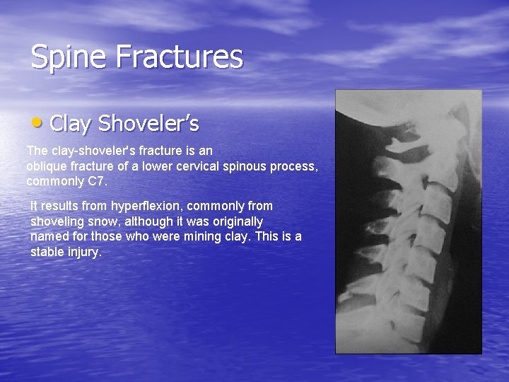 Spine Fractures • Clay Shoveler’s The clay-shoveler's fracture is an oblique fracture of a