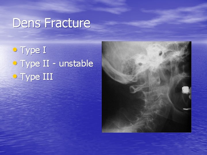 Dens Fracture • Type II - unstable • Type III 