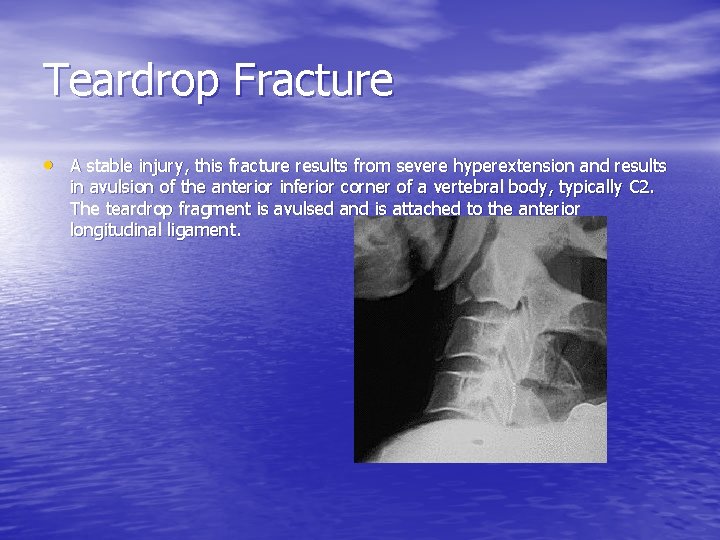 Teardrop Fracture • A stable injury, this fracture results from severe hyperextension and results