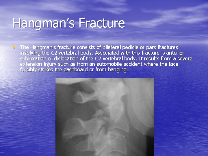 Hangman’s Fracture • The Hangman's fracture consists of bilateral pedicle or pars fractures involving