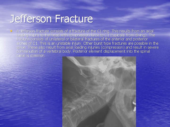 Jefferson Fracture • A Jefferson fracture consists of a fracture of the C 1