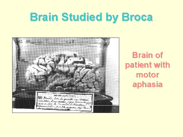 Brain Studied by Broca Brain of patient with motor aphasia 